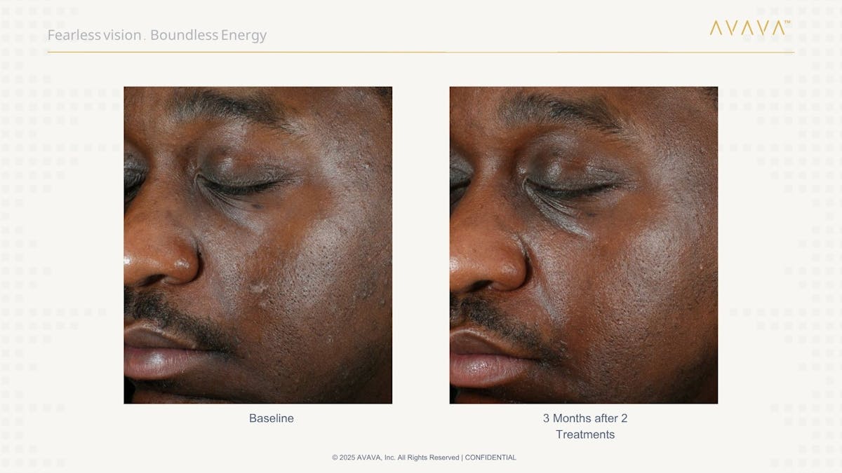 AVAVA Laser Before & After Gallery - Patient 336389 - Image 1