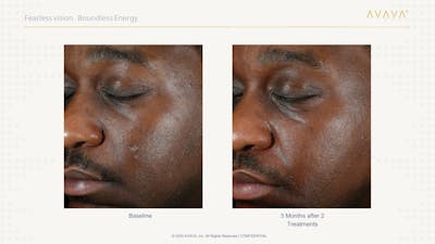 AVAVA Laser Before & After Gallery - Patient 336389 - Image 1