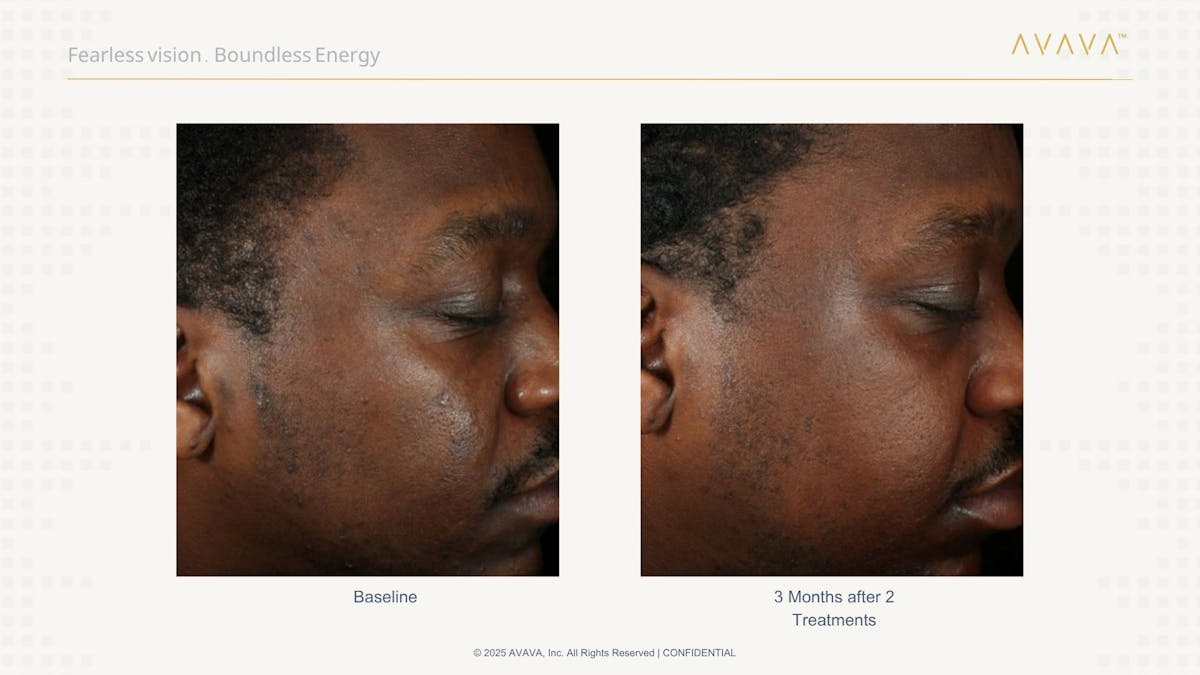 AVAVA Laser Before & After Gallery - Patient 336389 - Image 2