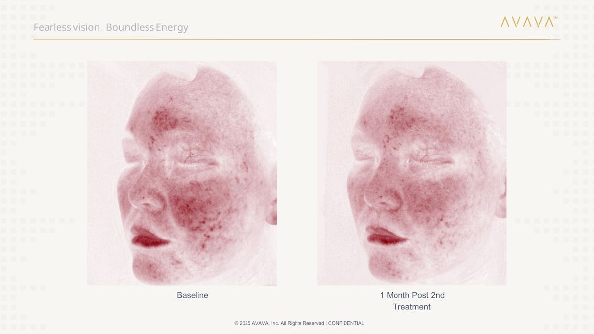 AVAVA Laser Before & After Gallery - Patient 165881 - Image 4