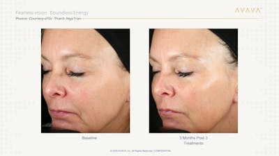 AVAVA Laser Before & After Gallery - Patient 368582 - Image 1