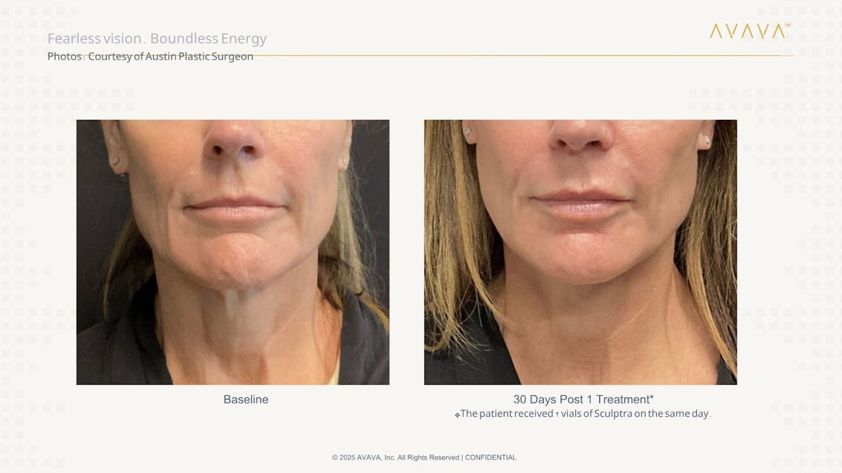 AVAVA Laser Before & After Gallery - Patient 277789 - Image 2