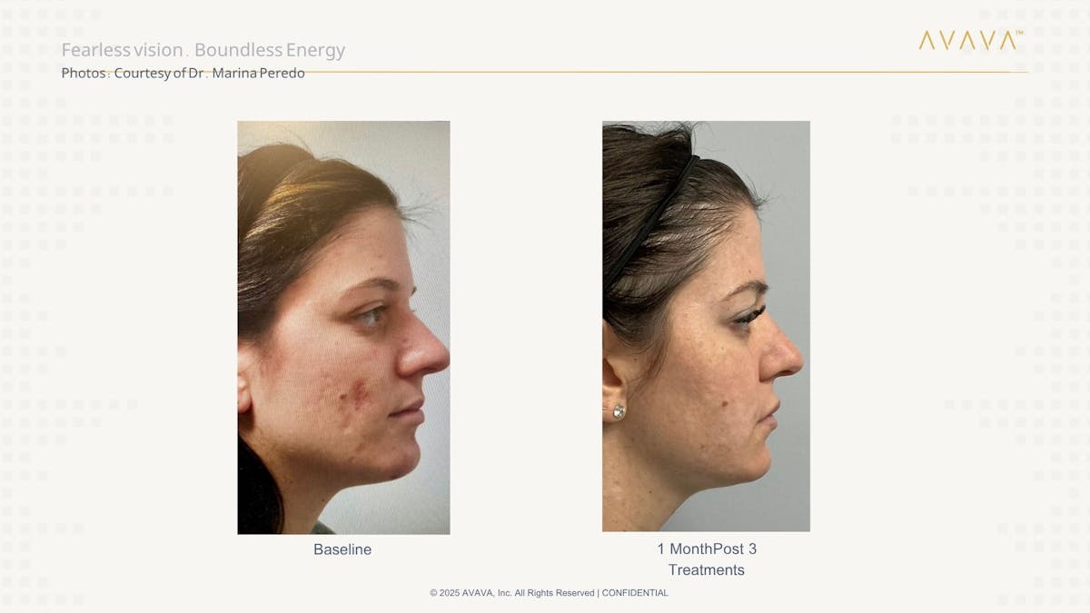 AVAVA Laser Before & After Gallery - Patient 532731 - Image 3