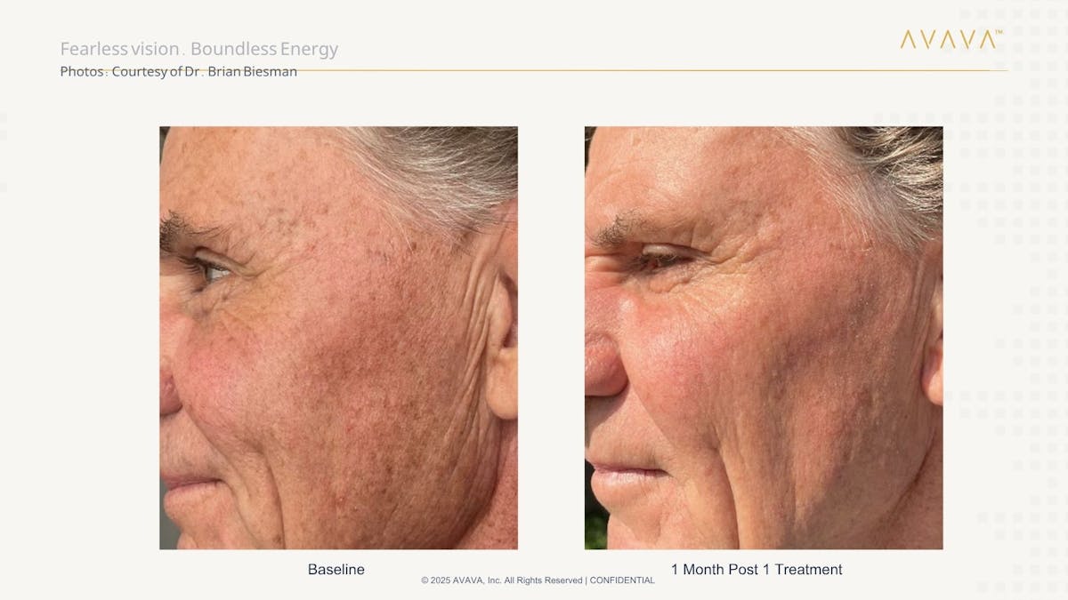 AVAVA Laser Before & After Gallery - Patient 318090 - Image 1
