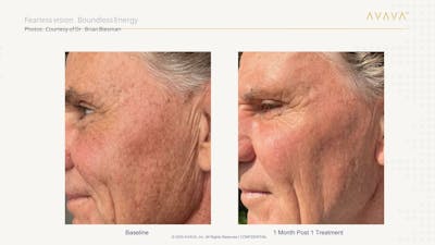 AVAVA Laser Before & After Gallery - Patient 318090 - Image 1