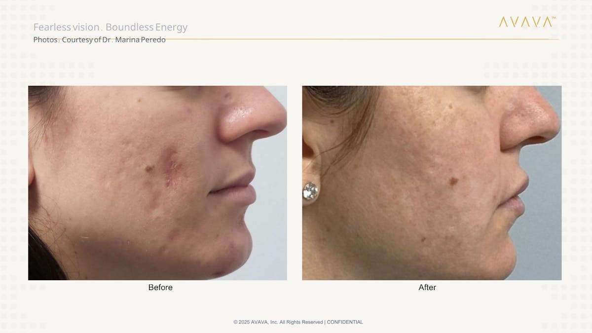 AVAVA Laser Before & After Gallery - Patient 532731 - Image 4