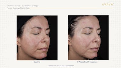 AVAVA Laser Before & After Gallery - Patient 264898 - Image 1