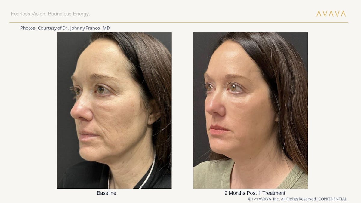 AVAVA Laser Before & After Gallery - Patient 425705 - Image 2
