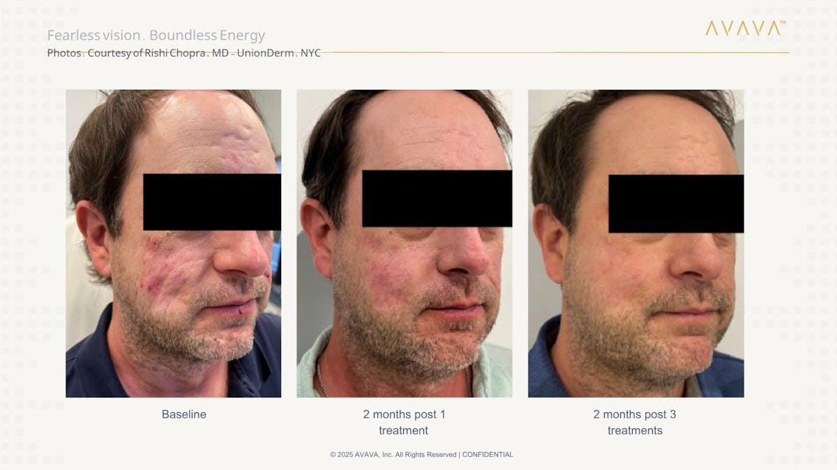AVAVA Laser Before & After Gallery - Patient 170637 - Image 2