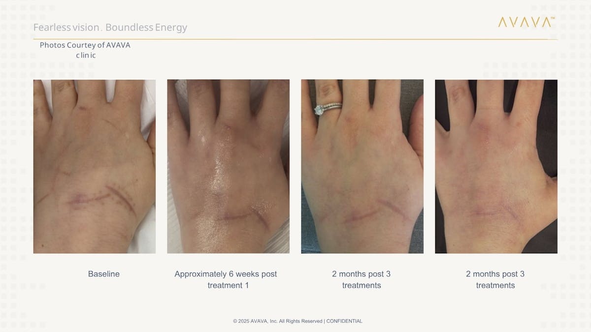 AVAVA Laser Before & After Gallery - Patient 259014 - Image 1