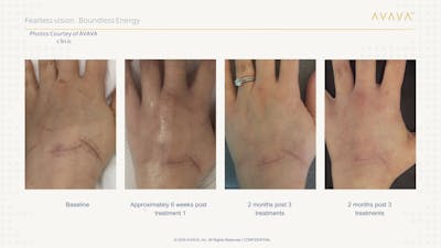 AVAVA Laser Before & After Gallery - Patient 259014 - Image 1
