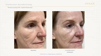 AVAVA Laser Before & After Gallery - Patient 413102 - Image 1
