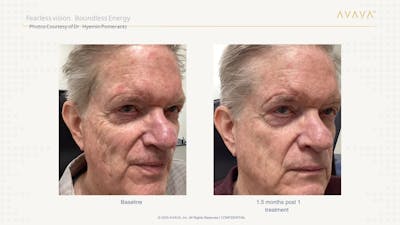 AVAVA Laser Before & After Gallery - Patient 173539 - Image 1