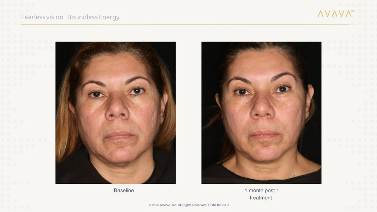 AVAVA Laser Before & After Gallery - Patient 132311 - Image 1