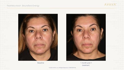 AVAVA Laser Before & After Gallery - Patient 132311 - Image 1