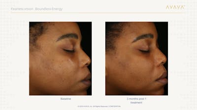 AVAVA Laser Before & After Gallery - Patient 324775 - Image 1