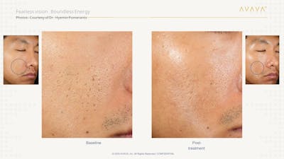 AVAVA Laser Before & After Gallery - Patient 108585 - Image 1