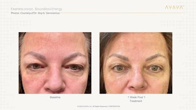 AVAVA Laser Before & After Gallery - Patient 391401 - Image 1