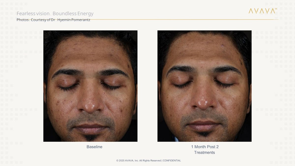 AVAVA Laser Before & After Gallery - Patient 107008 - Image 1