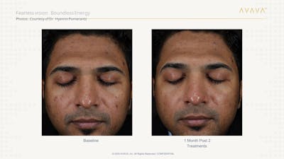 AVAVA Laser Before & After Gallery - Patient 107008 - Image 1