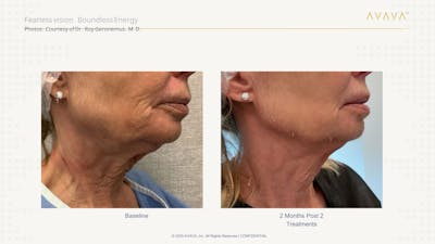 AVAVA Laser Before & After Gallery - Patient 328626 - Image 1