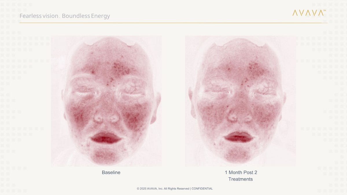 AVAVA Laser Before & After Gallery - Patient 165881 - Image 2