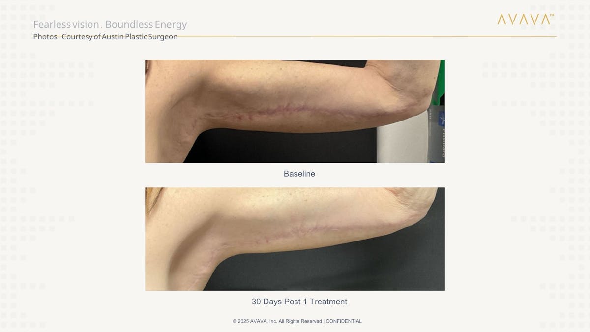 AVAVA Laser Before & After Gallery - Patient 315448 - Image 1