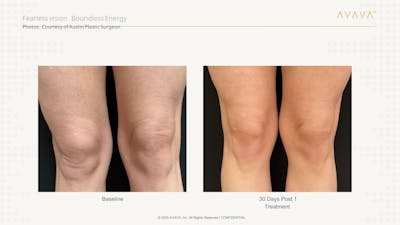 AVAVA Laser Before & After Gallery - Patient 121943 - Image 1