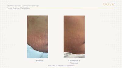 AVAVA Laser Before & After Gallery - Patient 286902 - Image 1