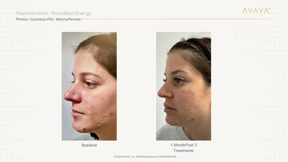 AVAVA Laser Before & After Gallery - Patient 532731 - Image 2