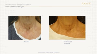 AVAVA Laser Before & After Gallery - Patient 344401 - Image 1