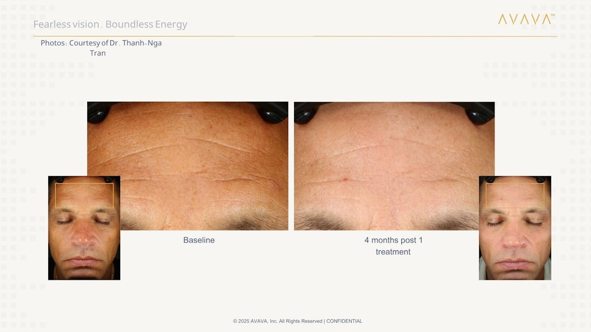 AVAVA Laser Before & After Gallery - Patient 232888 - Image 3