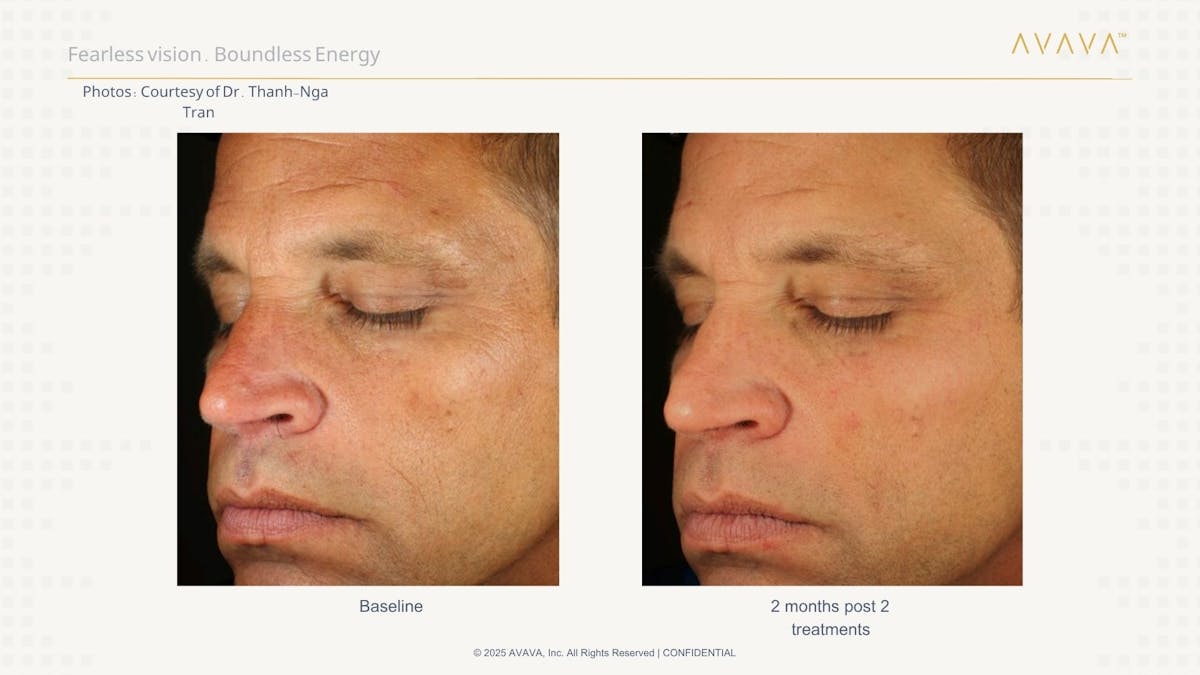AVAVA Laser Before & After Gallery - Patient 232888 - Image 2