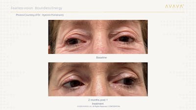 AVAVA Laser Before & After Gallery - Patient 331848 - Image 1