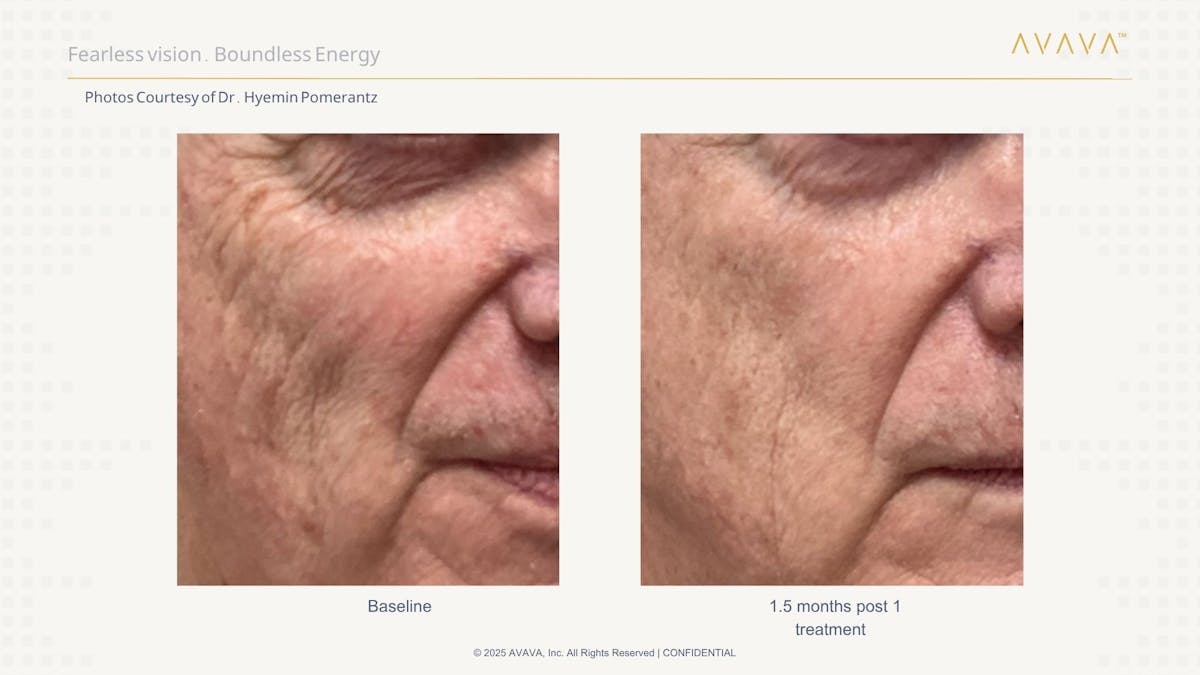 AVAVA Laser Before & After Gallery - Patient 173539 - Image 2