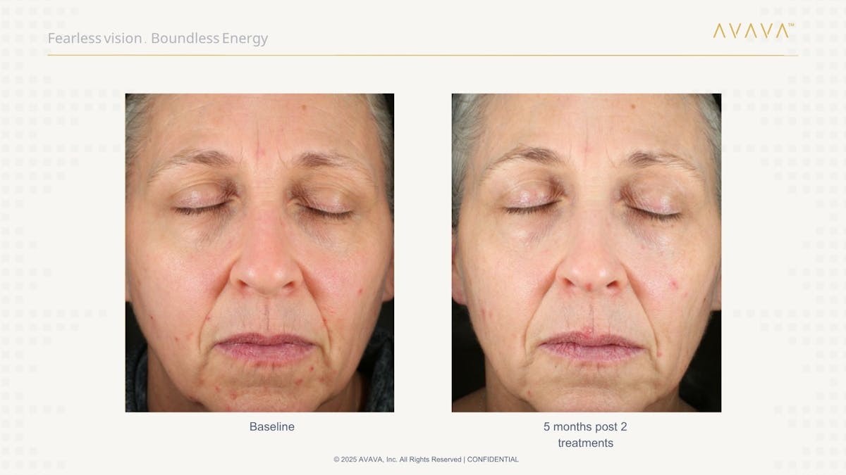 AVAVA Laser Before & After Gallery - Patient 325836 - Image 1