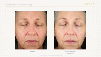 AVAVA Laser Before & After Gallery - Patient 325836 - Image 1
