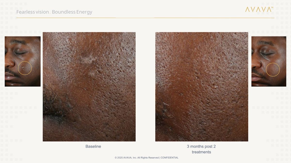 AVAVA Laser Before & After Gallery - Patient 336389 - Image 3