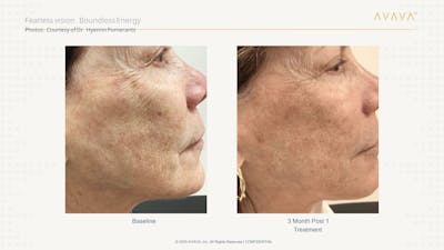AVAVA Laser Before & After Gallery - Patient 193589 - Image 1