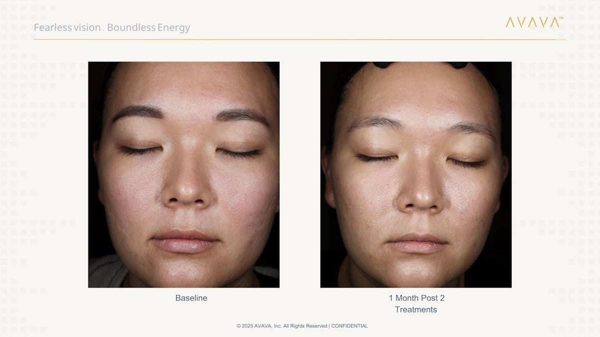 AVAVA Laser Before & After Gallery - Patient 165881 - Image 1