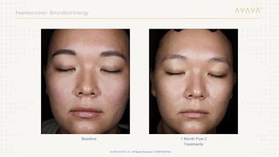 AVAVA Laser Before & After Gallery - Patient 165881 - Image 1