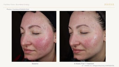 AVAVA Laser Before & After Gallery - Patient 296775 - Image 1