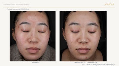 AVAVA Laser Before & After Gallery - Patient 358603 - Image 1