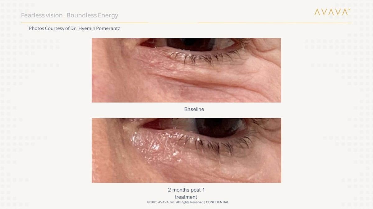 AVAVA Laser Before & After Gallery - Patient 331848 - Image 2