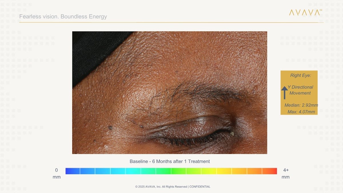 AVAVA Laser Before & After Gallery - Patient 821270 - Image 3