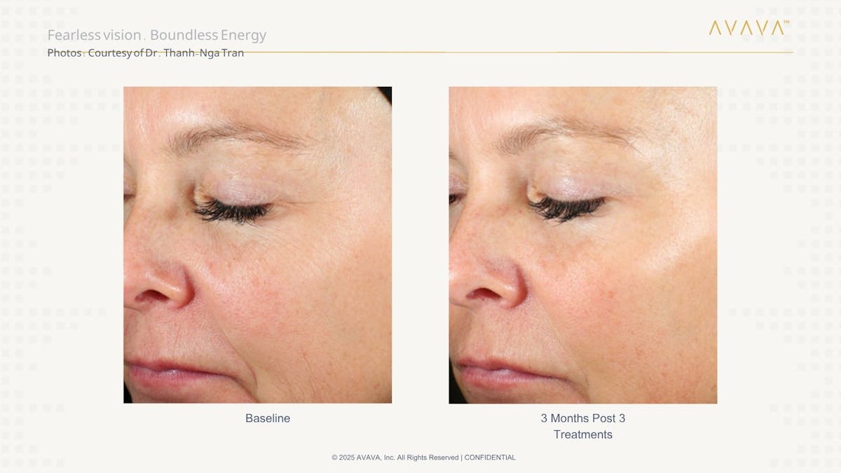 AVAVA Laser Before & After Gallery - Patient 368582 - Image 2