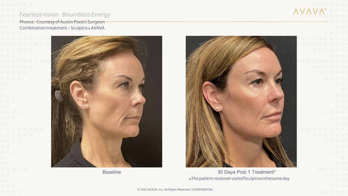 AVAVA Laser Before & After Gallery - Patient 277789 - Image 1