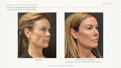 AVAVA Laser Before & After Gallery - Patient 277789 - Image 1