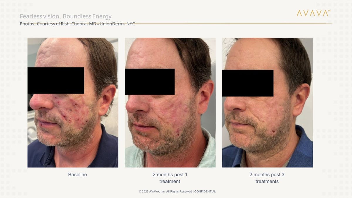 AVAVA Laser Before & After Gallery - Patient 170637 - Image 3