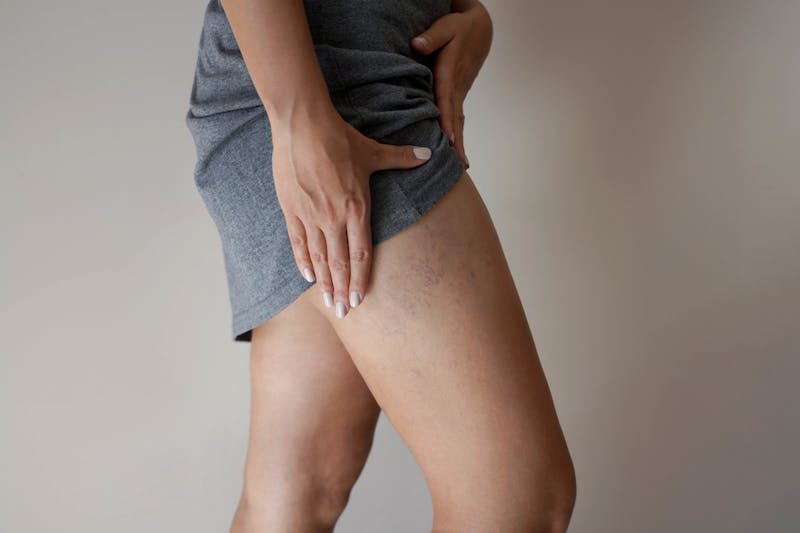 Woman showing veins on her leg